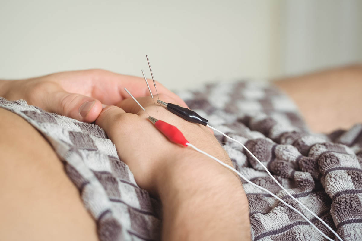 Key Benefits of Dry Needling for Athletes