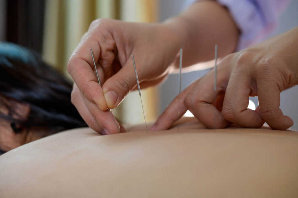 The Benefits of Dry Needling for Athletes How It Can Accelerate Recovery