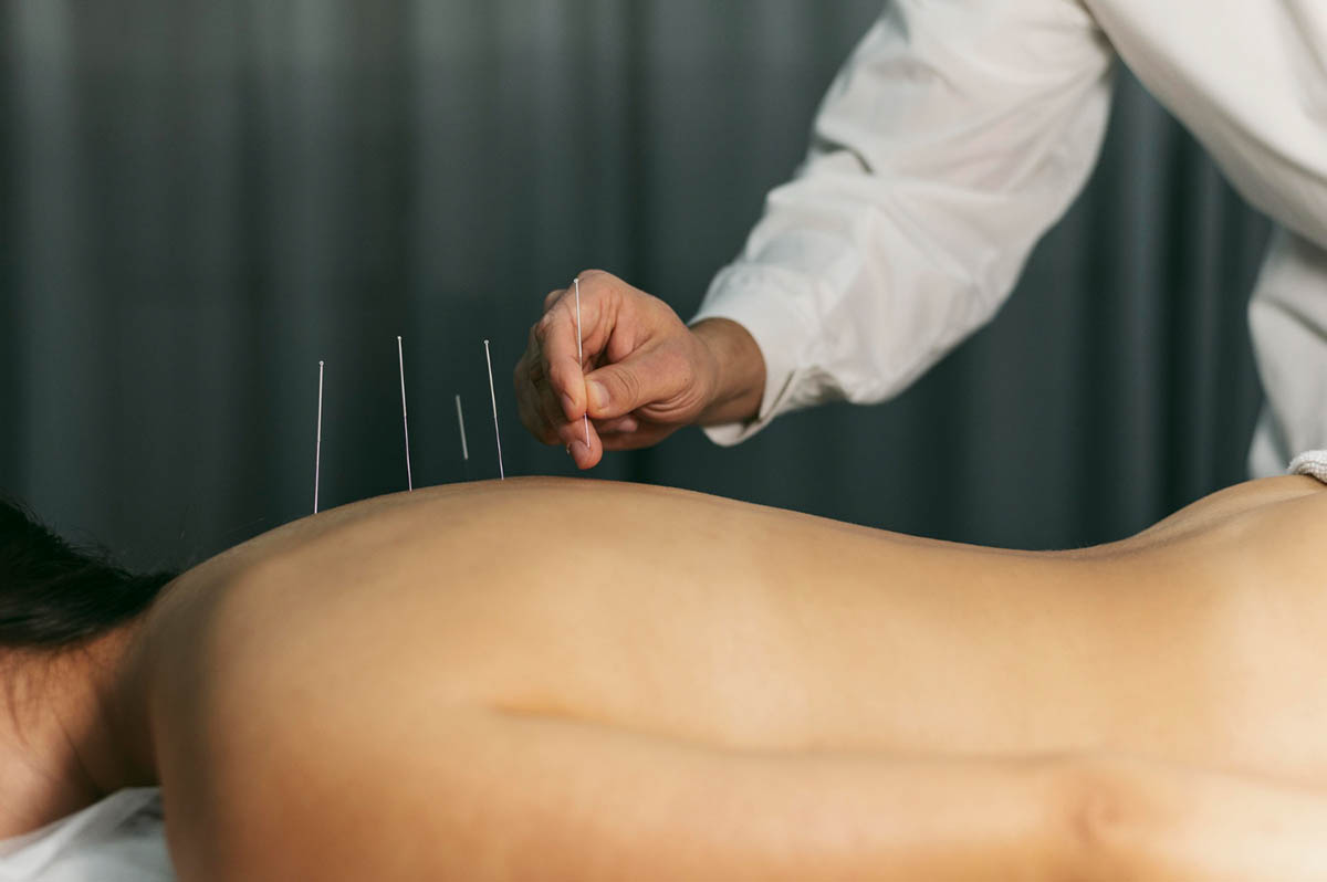 Preventing Future Injuries with Dry Needling