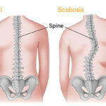 What Can Physical Therapy Do for Scoliosis Treatment?