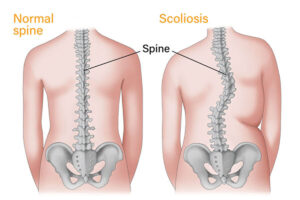 What Can Physical Therapy Do for Scoliosis Treatment?