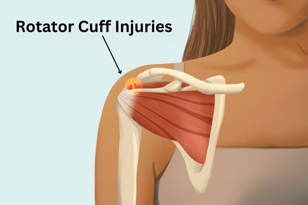 Rotator Cuff Injuries