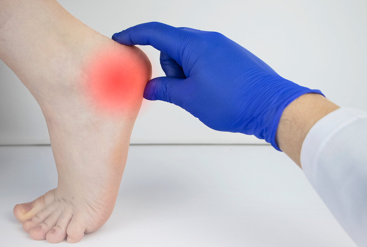 Achilles Tendonitis Recovery Time: How Long Does It Take?