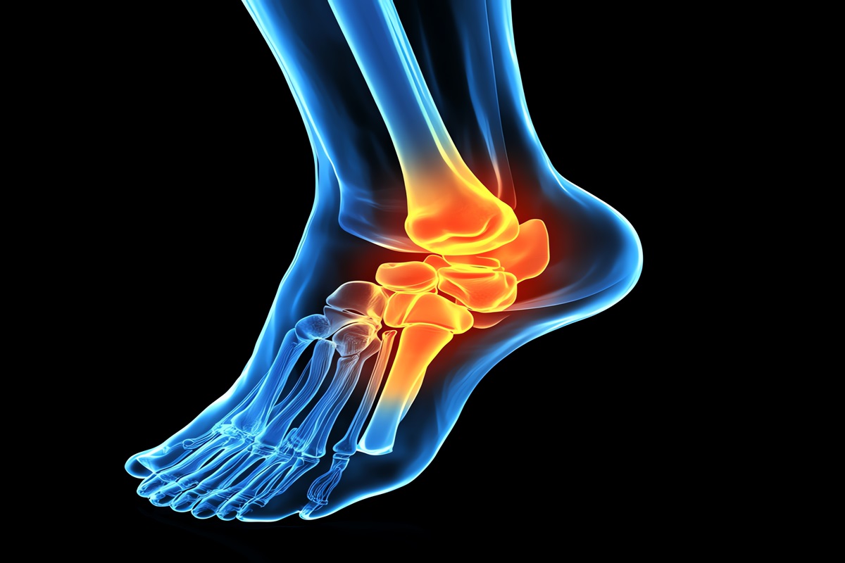 Tips to Prevent Recurrence of Achilles Tendonitis